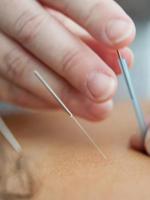 acupuncture needles and treatment